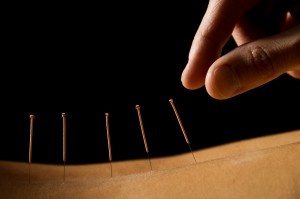 Acupuncture bradenton